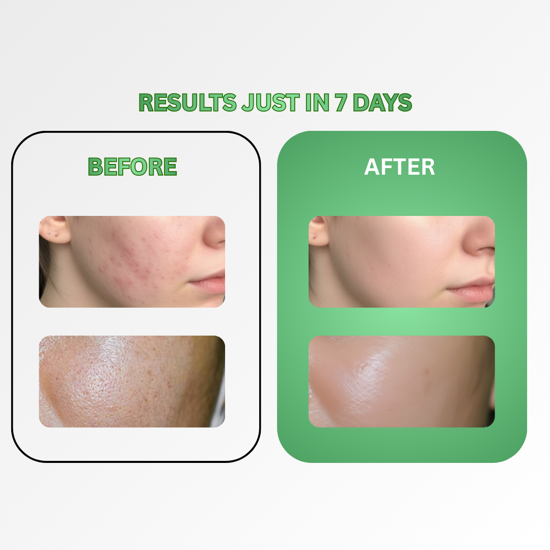 Acne Control In Just 7 Days
